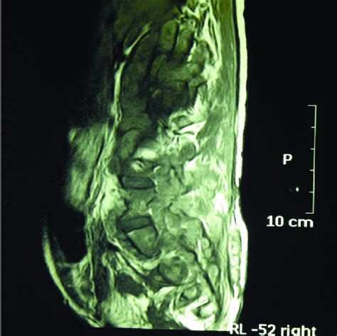 what medical test shows soft tissue in the back|mri for benign soft tissue.